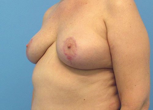 Breast Implant Removal Before and After | SGK Plastic Surgery