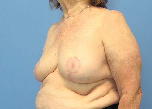 Breast Implant Removal Before and After | SGK Plastic Surgery