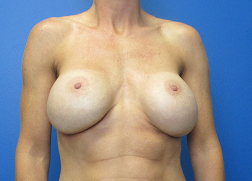 Breast Implant Removal Before and After | SGK Plastic Surgery