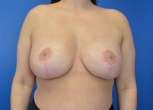 Breast Implant Removal Before and After | SGK Plastic Surgery