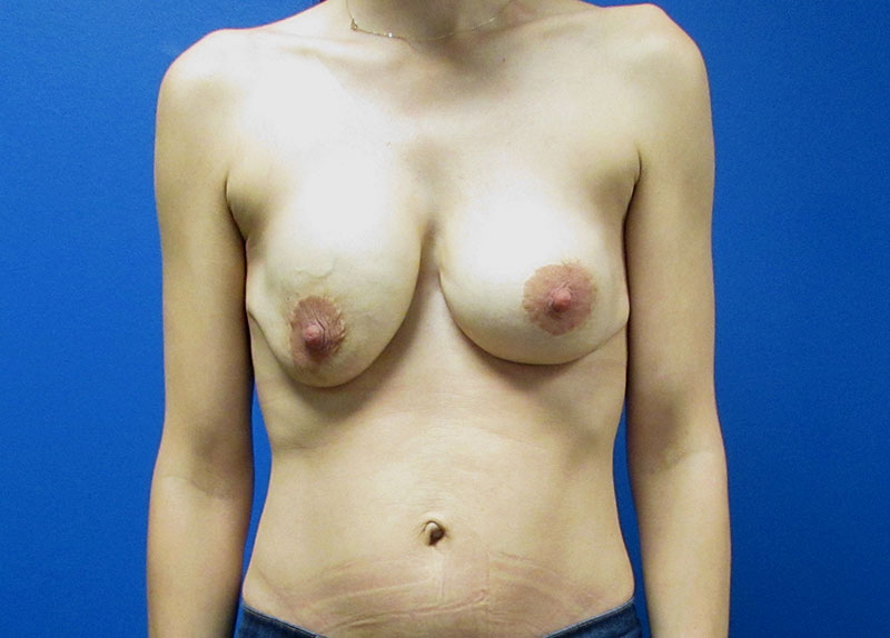 Breast Implant Removal Before and After | SGK Plastic Surgery