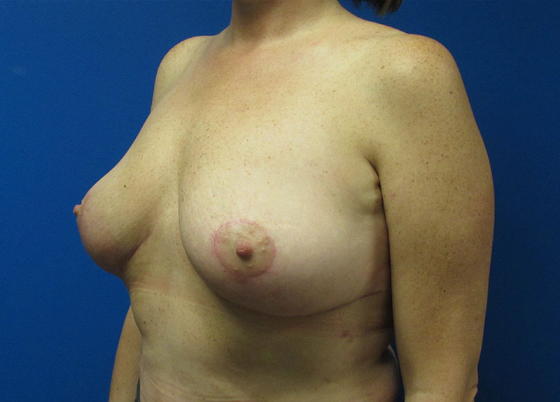 Breast Implant Removal Before and After | SGK Plastic Surgery