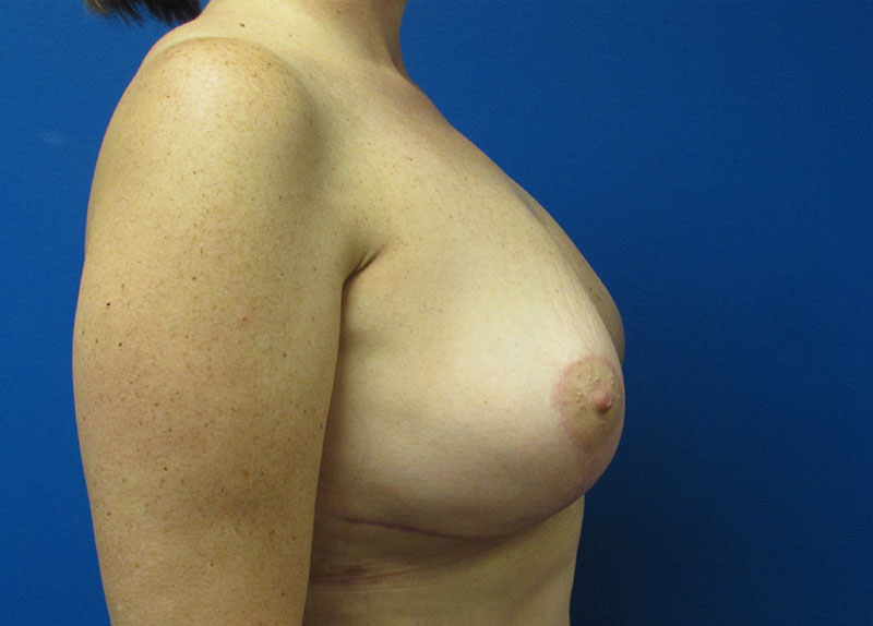 Breast Implant Removal Before and After | SGK Plastic Surgery