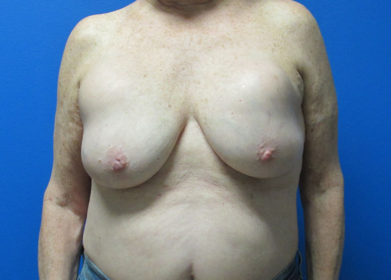 Breast Implant Removal Before and After | SGK Plastic Surgery