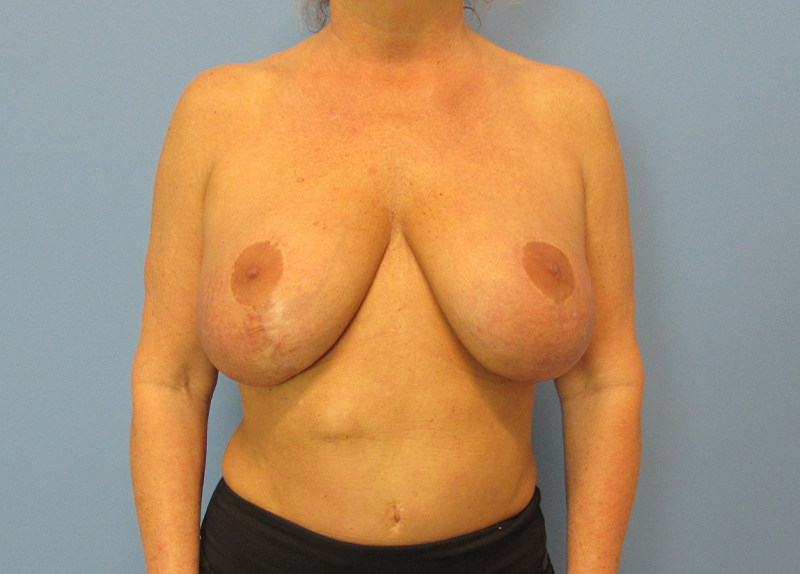 Breast Implant Removal Before and After | SGK Plastic Surgery