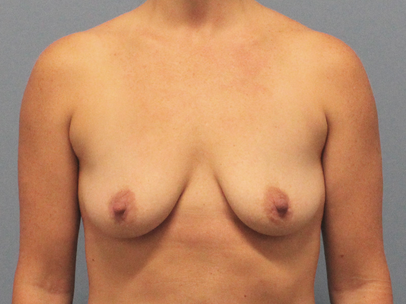 Breast Lift Augmentation Before and After | SGK Plastic Surgery