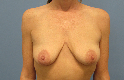 Breast Lift Augmentation Before and After | SGK Plastic Surgery