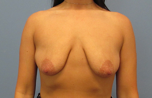 Breast Lift Augmentation Before and After | SGK Plastic Surgery