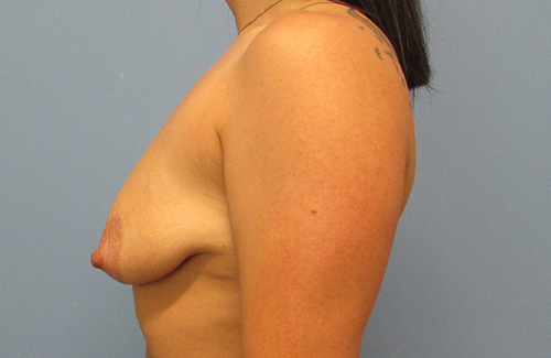 Breast Lift Augmentation Before and After | SGK Plastic Surgery