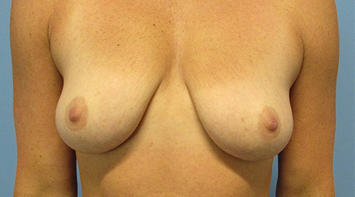 Breast Lift Augmentation Before and After | SGK Plastic Surgery