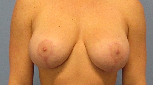 Breast Lift Augmentation Before and After | SGK Plastic Surgery