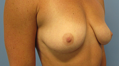 Breast Lift Augmentation Before and After | SGK Plastic Surgery