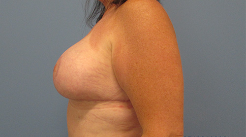 Breast Lift Augmentation Before and After | SGK Plastic Surgery