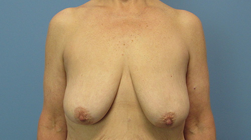 Breast Lift Augmentation Before and After | SGK Plastic Surgery