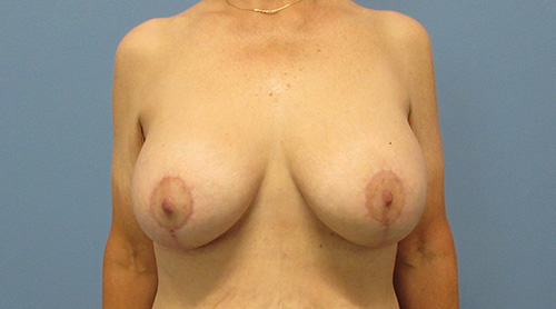Breast Lift Augmentation Before and After | SGK Plastic Surgery