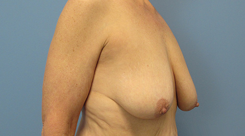 Breast Lift Augmentation Before and After | SGK Plastic Surgery