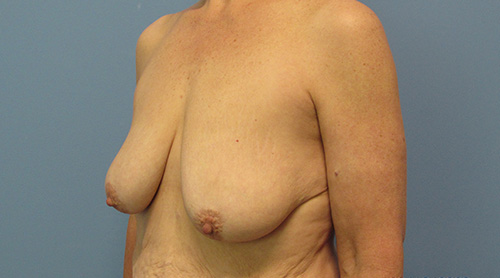 Breast Lift Augmentation Before and After | SGK Plastic Surgery