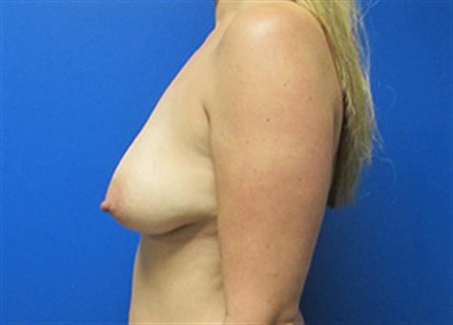 Breast Lift Augmentation Before and After | SGK Plastic Surgery