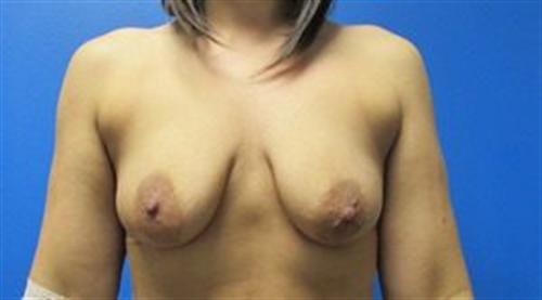 Breast Lift Augmentation Before and After | SGK Plastic Surgery