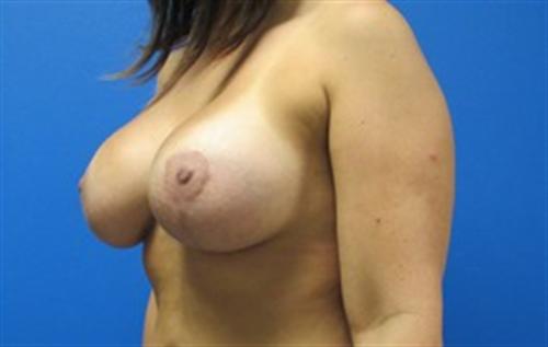 Breast Lift Augmentation Before and After | SGK Plastic Surgery