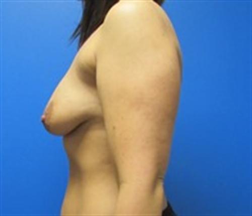 Breast Lift Augmentation Before and After | SGK Plastic Surgery