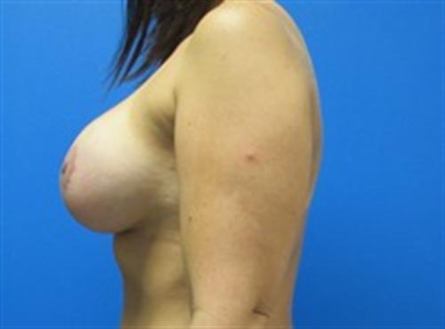 Breast Lift Augmentation Before and After | SGK Plastic Surgery