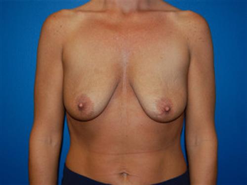 Breast Lift Augmentation Before and After | SGK Plastic Surgery