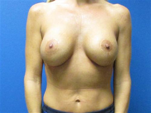 Breast Lift Augmentation Before and After | SGK Plastic Surgery