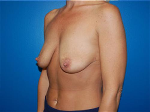 Breast Lift Augmentation Before and After | SGK Plastic Surgery