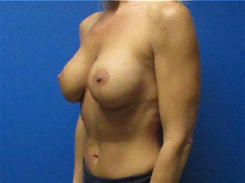 Breast Lift Augmentation Before and After | SGK Plastic Surgery