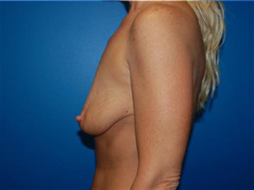 Breast Lift Augmentation Before and After | SGK Plastic Surgery