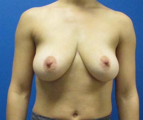 Breast Lift Augmentation Before and After | SGK Plastic Surgery