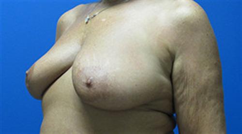 Breast Lift Augmentation Before and After | SGK Plastic Surgery