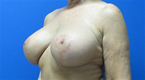 Breast Lift Augmentation Before and After | SGK Plastic Surgery