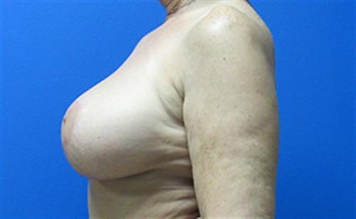 Breast Lift Augmentation Before and After | SGK Plastic Surgery