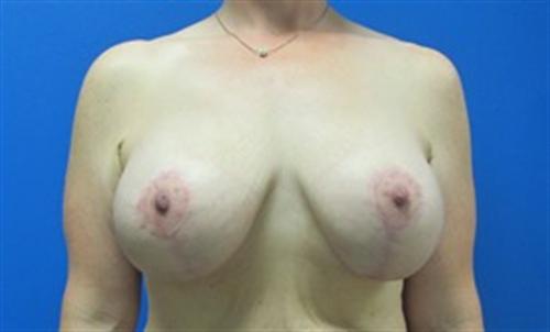 Breast Lift Augmentation Before and After | SGK Plastic Surgery