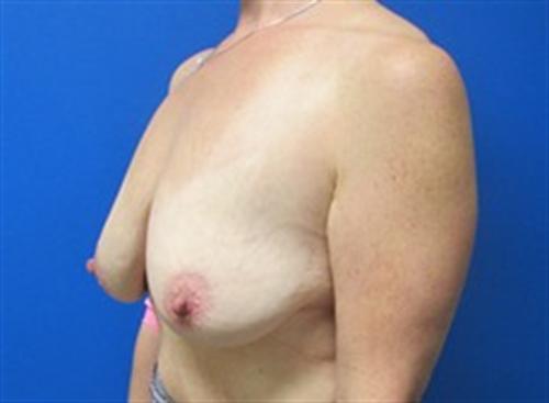 Breast Lift Augmentation Before and After | SGK Plastic Surgery