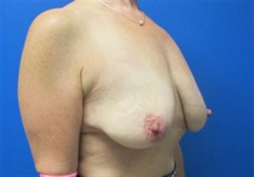 Breast Lift Augmentation Before and After | SGK Plastic Surgery