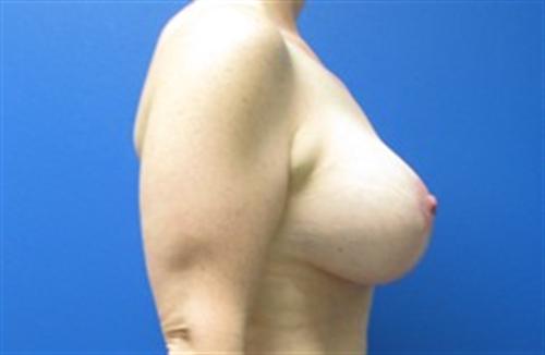 Breast Lift Augmentation Before and After | SGK Plastic Surgery