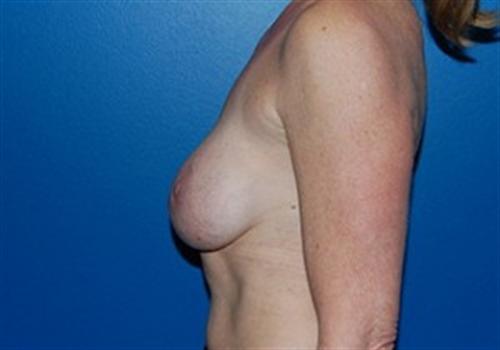 Breast Lift Augmentation Before and After | SGK Plastic Surgery