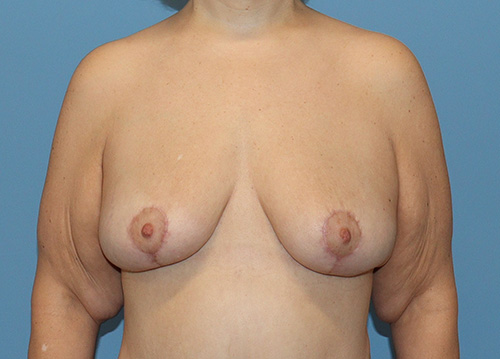 Breast Lift Before and After | SGK Plastic Surgery