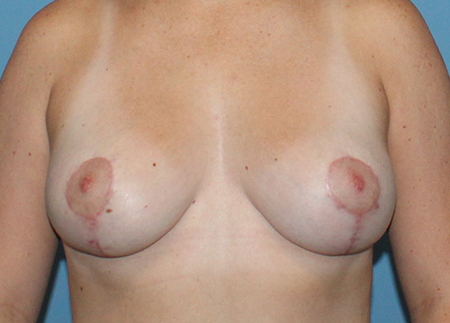 Breast Lift Before and After | SGK Plastic Surgery