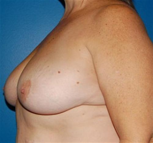 Breast Lift Before and After | SGK Plastic Surgery