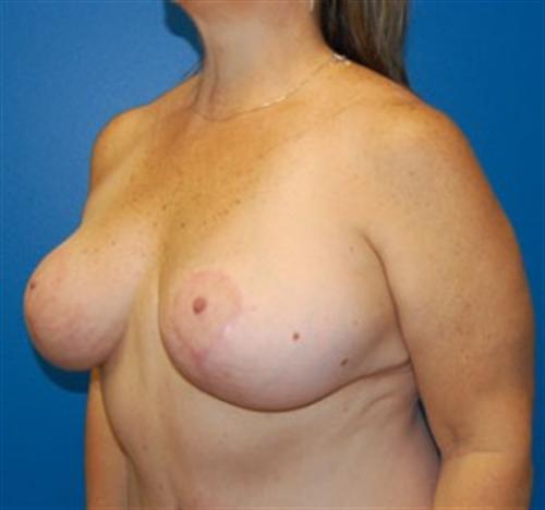 Breast Lift Before and After | SGK Plastic Surgery