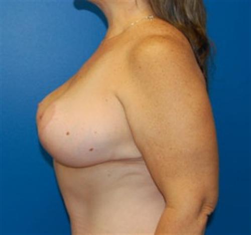 Breast Lift Before and After | SGK Plastic Surgery