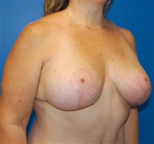 Breast Lift Before and After | SGK Plastic Surgery