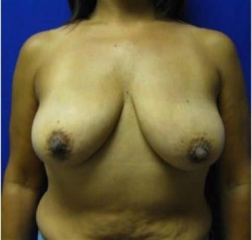 Breast Lift Before and After | SGK Plastic Surgery