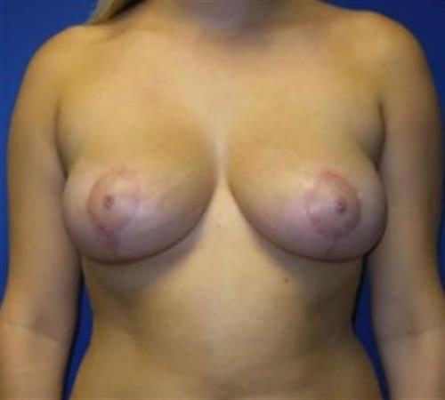 Breast Lift Before and After | SGK Plastic Surgery