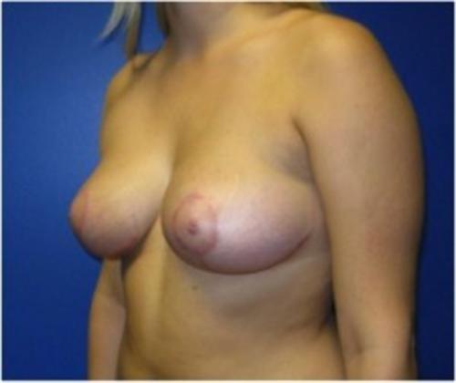 Breast Lift Before and After | SGK Plastic Surgery