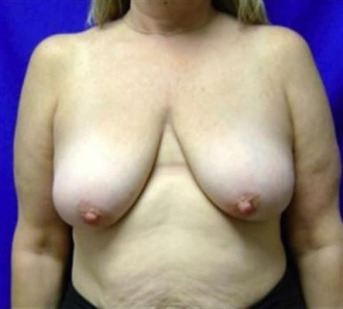 Breast Lift Before and After | SGK Plastic Surgery